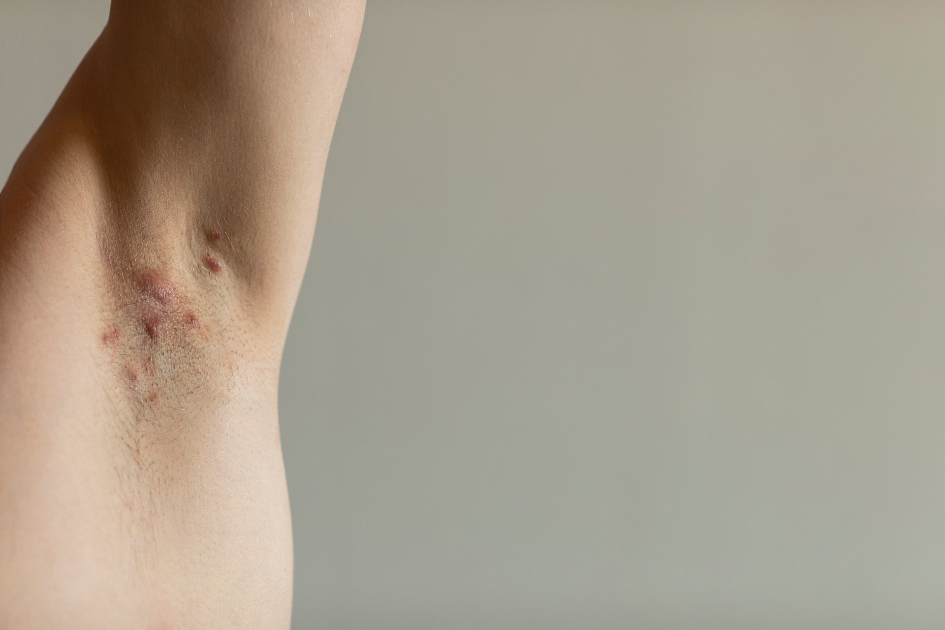 Acne inversa of ontstekingen in de liezen of oksels | Laserkliniek